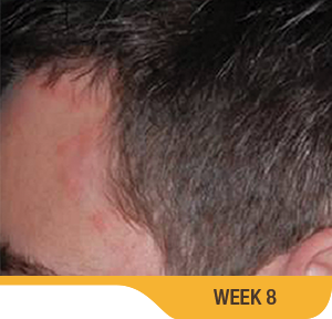Baseline And 8 Weeks Scalp Results Photo Of An Actual Patient Who Achieved Treatment Success With SORILUX Foam