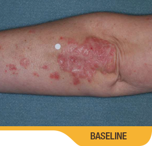 Baseline And 8 Weeks Elbow Results Photo Of An Actual Patient Who Achieved Treatment Success With SORILUX Foam