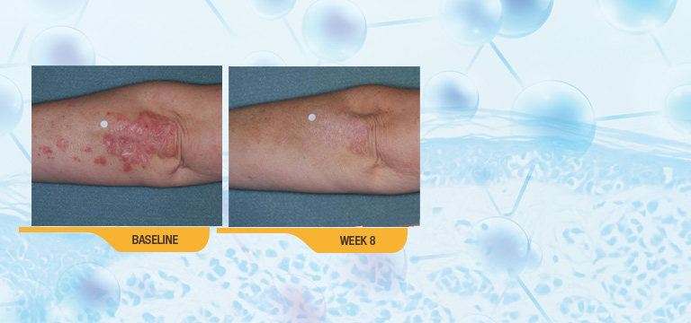 The Results Speak For Themselves. SORILUX Foam Has Been Proven Effective For Body Psoriasis