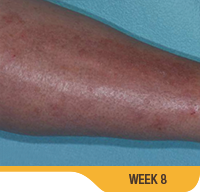 Baseline And 8 Weeks Leg Results Photo Of An Actual Patient Who Achieved Treatment Success With SORILUX Foam